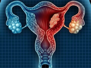 Курс оздоровления при онкологии матки. Рак шейки матки