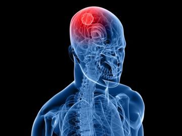 Курс оздоровления при онкологии головного мозга